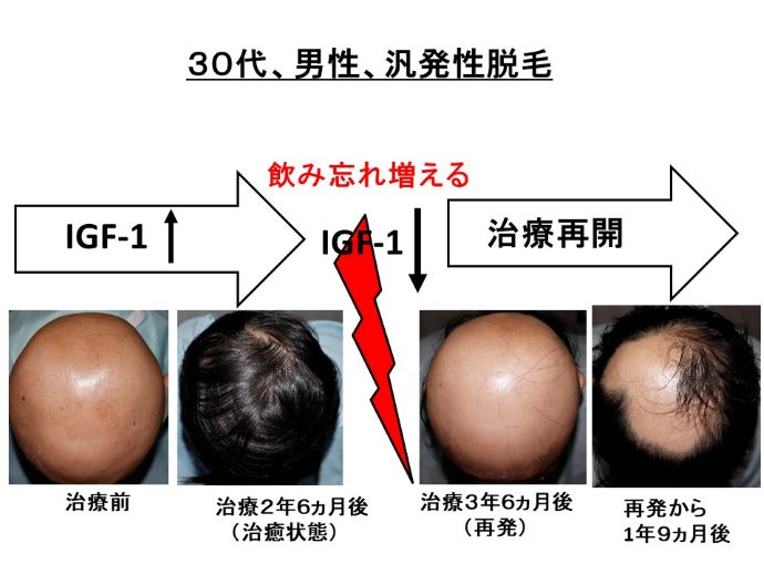 円形脱毛症　病院